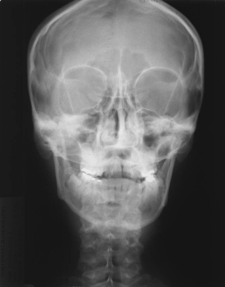 pa cephalometric x ray